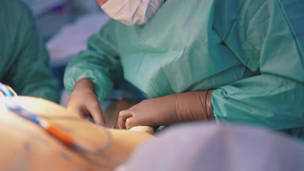 ボディリフティング プラスチック手術中の患者の体 安全手袋の医師は 手術室で医療処置を行っています クローズアップ — ストック動画