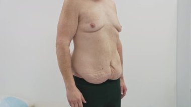 Vücudu sarkık çıplak bir hasta. Klinikteki liposuction ameliyatından önce. Adam kilo verdikten sonra vücudunun sorunlu kısımlarını gösteriyor.