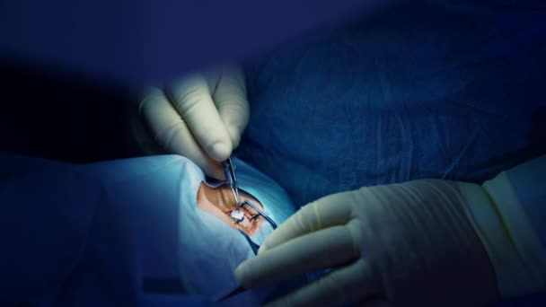 Procedura Chirurgicală Ochiul Pacientului Deschis Oftalmolog Profesionist Mănuși Sterile Care — Videoclip de stoc