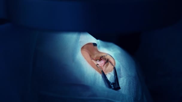 Laserowa Korekcja Wzroku Doktor Operuje Oko Oko Pacjenta Podczas Operacji — Wideo stockowe