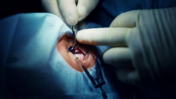 Лечение Глаз Операция Глазу Пациенту Профессиональный Врач Проводит Офтальмологическую Процедуру — стоковое видео