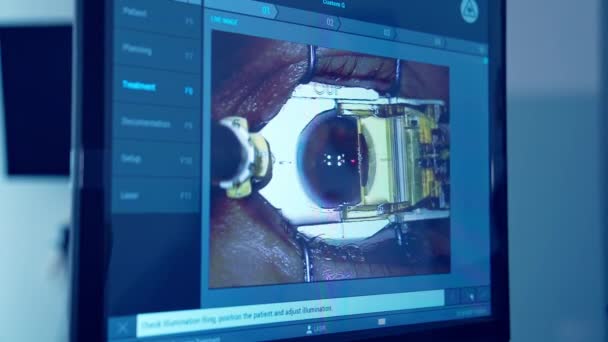 Tratamentul Ochilor Laser Ecran Unui Monitor Monitor Calculator Chirurgie Oculară — Videoclip de stoc