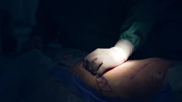 Liposukcja Brzucha Chirurdzy Pompują Tłuszcz Brzucha Pacjenta Punkt Operacyjny Usuwanie — Wideo stockowe