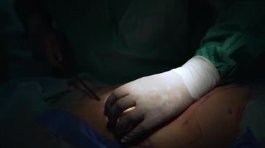 Plastik cerrah karnından yağ pompalıyor. Hastanın karnında yağ aldırma. Yağ transferi ameliyatı. Aşırı kilolu hastaya cerrahi müdahale. Yakın plan..