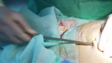 Karındaki yağı çıkarmak için cerrahi işlem. Doktor özel bir cerrahi aletle hastanın karnına liposuction uyguluyor. Yakın plan..