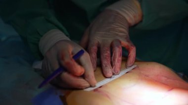 Doktor ameliyat sırasında hastanın karnına çizgi çekiyor. Yağ aldırma işlemi sırasında karın bölgesinde kan olan eldivenli cerrahın elleri. Yakın plan..
