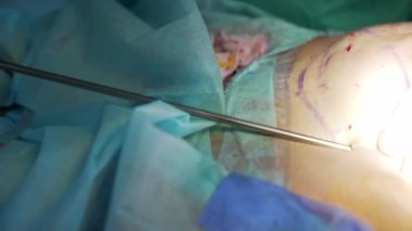 Cerrahi yağ aldırma işlemi. Karnından yağ çıkartıyor. Yağ transferi için estetik ameliyat sırasında doktorun elindeki cerrahi alet. Yakın plan..