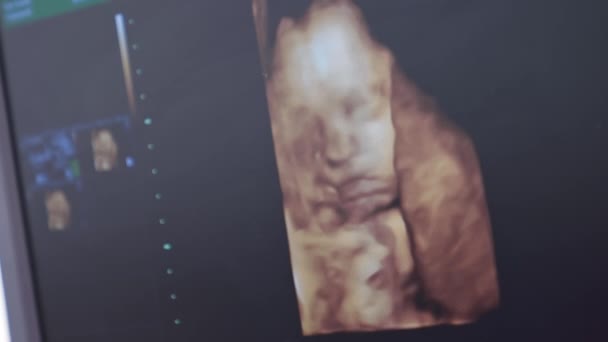 Embryon Humain Couleur Sur Écran Lors Échographie Échographie Femme Enceinte — Video