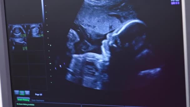 妊娠した女性の超音波 小さな赤ちゃんがお母さんの腹の中を回っています 母親の胎内の赤ちゃんは ソノグラフィーの間に移動しています — ストック動画