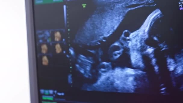 Dynamic Ultrasound Image Embryo Screen Tiny Baby Turning Mother Belly — Stock Video