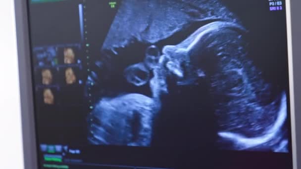 屏幕显示了一个未来的孩子在超声检查 婴儿在超声波扫描与心跳的声音 超声怀孕 胎儿检查人类胚胎 医生的手在监视器上显示婴儿 — 图库视频影像