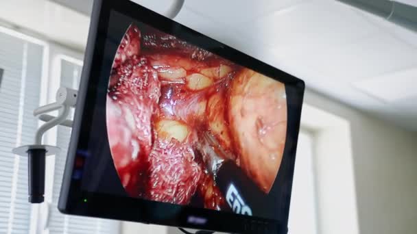 Хирургический Монитор Время Оперативной Процедуры Экран Показывающий Медицинский Процесс Вмешательства — стоковое видео