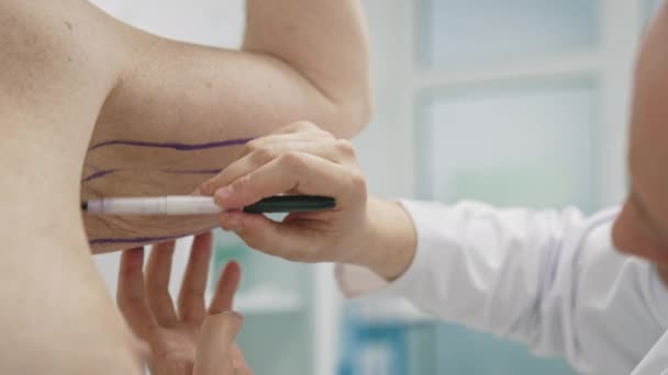 Пластичний Хірург Готує Пацієнта Операції Ліпосакції Доктор Малює Лінії Чоловічому — стокове відео