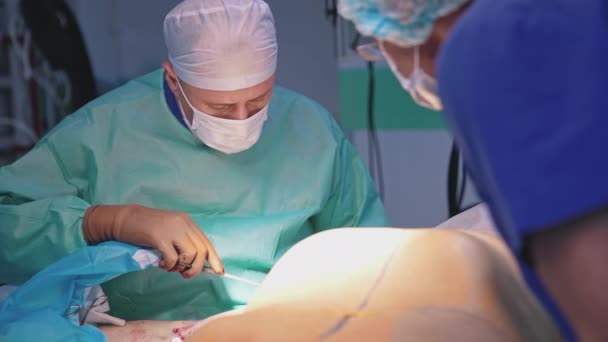 Liposuccion Chirurgicale Ventre Équipe Chirurgiens Faisant Chirurgie Plastique Dans Une — Video