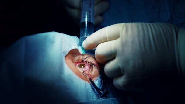 Koreksi Penglihatan Laser Pasien Ruang Operasi Selama Operasi Oftalmik — Stok Video