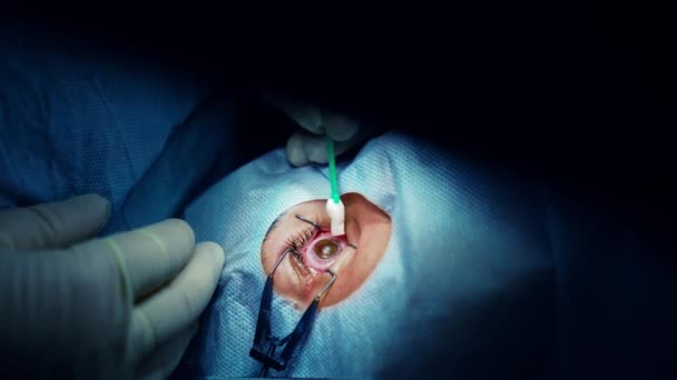 Korrigering Laserseende Patient Och Ett Team Kirurger Operationssalen Ögonkirurgi Ögonlocksspekulum — Stockvideo