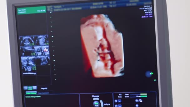母亲子宫里的超声波婴儿 孕妇的超声波检查 科学分析 — 图库视频影像