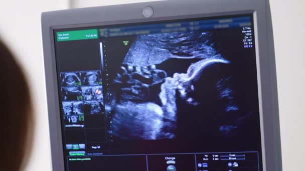 Ultradźwiękowe Dziecko Łonie Matki Nowoczesne Badanie Ultrasonograficzne Czasie Ciąży — Wideo stockowe