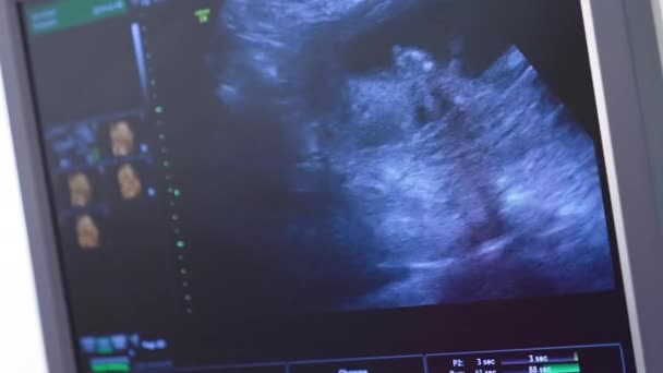 Bebê Útero Mãe Está Movendo Durante Ultrassonografia Ecrã Ultrassonográfico — Vídeo de Stock