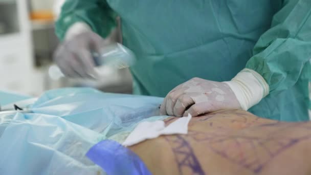 身体提升 整形手术中病人的身体 戴安全手套的医生在手术室里执行医疗程序 后续行动 — 图库视频影像