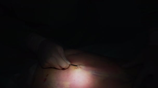 患者の腹部に対する外科的処置 脂肪を除去する手術器具 ブラックバックでのリポジション 操作のライト スポット クローズアップ — ストック動画