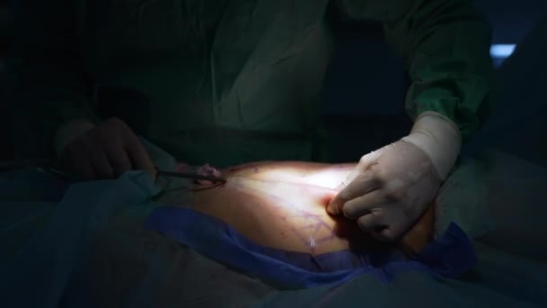 医生在手术期间给病人的腹部划了一条线 在抽脂过程中 医生手戴手套 腹部有血 后续行动 — 图库视频影像