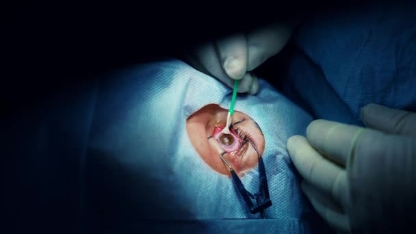 Laserová Operace Očí Moderní Nemocnici Korekce Zraku Lékaře — Stock video