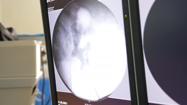 Černobílá Obrazovka Ultrazvukovým Zobrazením Vnitřních Orgánů Pacienta Technologie Napomáhající Během — Stock video