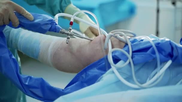 Uraz Kolana Nowoczesnej Sali Operacyjnej Chirurg Włożył Sprzęt Medyczny Nogi — Wideo stockowe