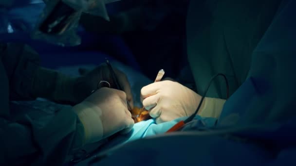 侵攻の場所にスポットライトが付いた暗い部屋での外科手術 2人の医師の手が彼らの仕事で医療ツールを使用しています — ストック動画