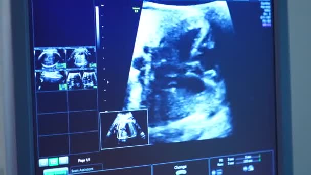 一个显示孕妇腹部的超声波仪器的蓝色屏幕 医生检查怀孕情况 — 图库视频影像