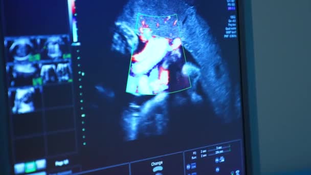 Blå Monitor Som Visar Babyrörelsen Mammas Mage Närbild Ultraljudsundersökning Graviditet — Stockvideo