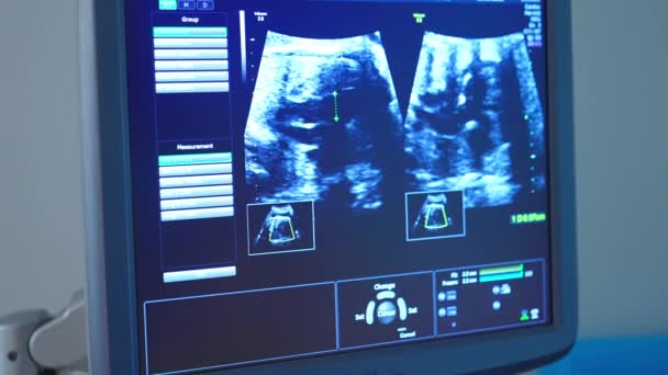 Ekran Usg Ciąży Klinice Sprzęt Usg Pojęcie Macierzyństwa Opieki Zdrowotnej — Wideo stockowe