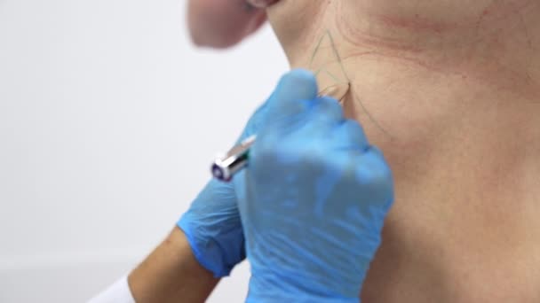 戴蓝色乳胶手套的手在女人的腹部画线 病人准备接受腹部整形手术 靠近点 — 图库视频影像