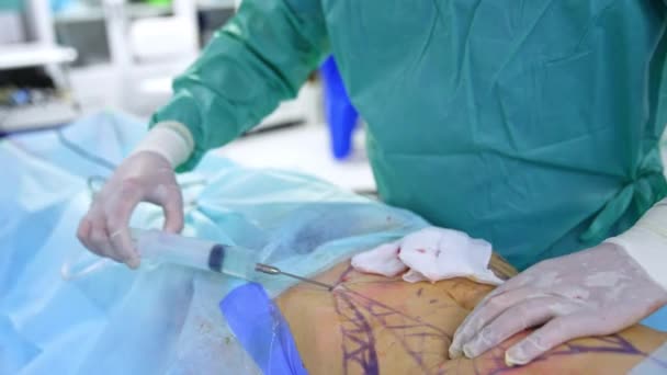 在大注射器的帮助下 医生正在将药物插入病人的腹部 女性腹部整形外科吸脂术 — 图库视频影像