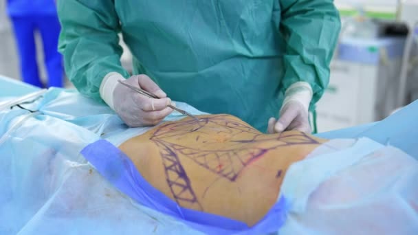 裸の腹と適用されたラインを持つ患者は 手術テーブルの上にあります スカルペルを持っている医師の手は 切断を作る操作を開始します — ストック動画