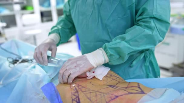 Liposukce Probíhá Zavřít Zkušený Chirurg Vkládá Těla Pacienta Léky Injekční — Stock video