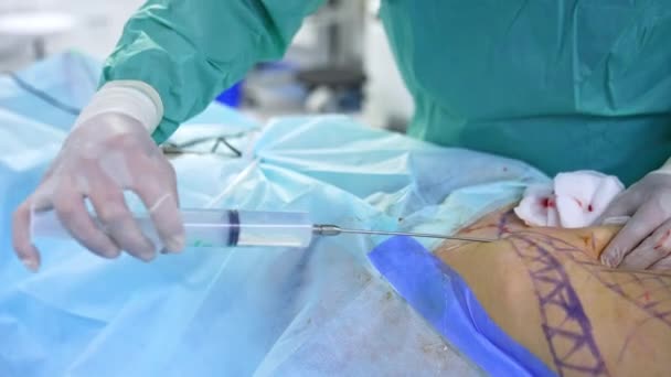 患者さんの腹に薬を注入する巨大な注射器で素早く動く医師 プラスチック手術の近代クリニックにおける脂肪吸引手術 — ストック動画
