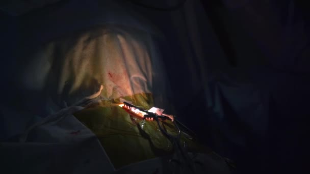 Λεπτή Νευροχειρουργική Επέμβαση Διεξάγεται Στο Σκοτεινό Χειρουργικό Δωμάτιο Γάντια Χέρια — Αρχείο Βίντεο