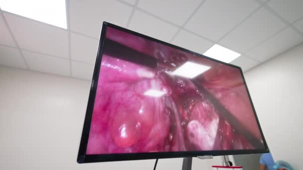 Βραχίονες Των Οργάνων Χειρίζονται Εσωτερικό Όργανο Μεγάλη Οθόνη Στο Χειρουργείο — Αρχείο Βίντεο