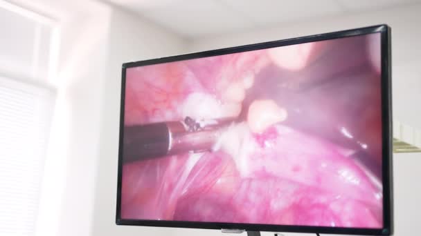 Υψηλής Ακρίβειας Λειτουργία Χρήση Σύγχρονων Οργάνων Οθόνη Που Δείχνει Χειρουργική — Αρχείο Βίντεο