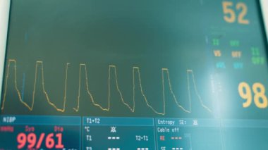 Eğri çizgi ameliyat odasındaki modern ekipman ekranında hareket ediyor. Yaşam parametrelerini gösteren ekran çalışması.