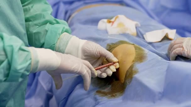 医生的手戴着乳胶手套给病人的膝盖打了针 靠近点现代医院干细胞手术 — 图库视频影像