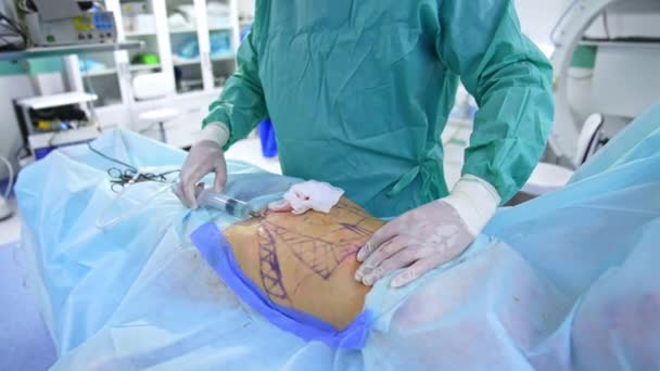 Χειρουργική Λιποαναρρόφησης Κοιλίας Εξέλιξη Άντρας Χειρουργός Χώνει Την Τεράστια Σύριγγα — Αρχείο Βίντεο