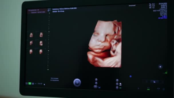 現代の超音波装置のスクリーンのかわいい生まれていない赤ん坊の映像 患者の状態を確認する装置の前に座っている女性の専門家 — ストック動画