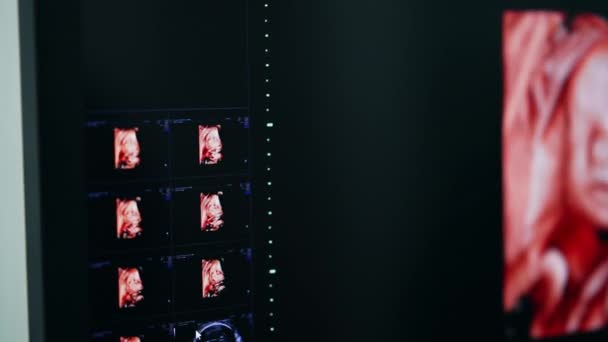 赤ちゃんの出生前のショットの多様な角度の写真が付いている黒いモニター クローズアップ 現代の診療所での妊娠診断のための超音波 — ストック動画