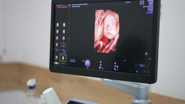 带有未出生婴儿产前照片的黑色监视器 现代设备上对孕妇的超声诊断 — 图库视频影像