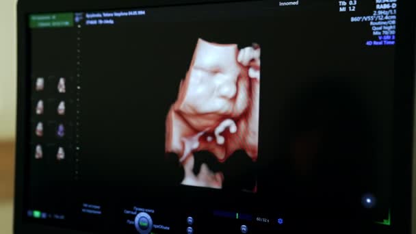 Kleine Babygesichter Und Hände Auf Dem Schwarzen Bildschirm Des Ultraschallgeräts — Stockvideo
