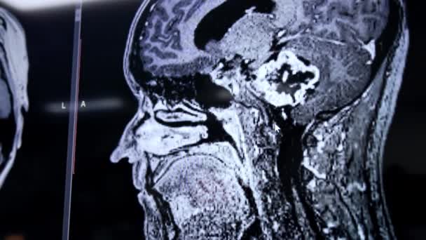 黒と白のMriが手術室で大きなスクリーンを撮影した クローズアップ モニターのヘッド画像を閉じる — ストック動画