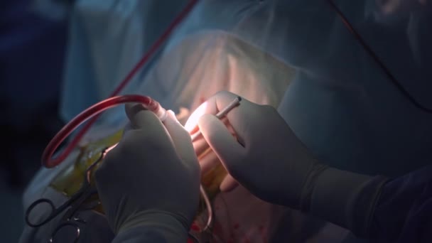 Vista Perto Trabalho Neurocirurgia Médico Neurocirurgião Especialistas Uniforme — Vídeo de Stock